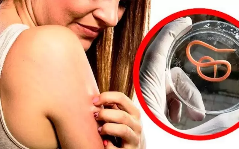 kegatalan dan kerengsaan akibat parasit dalam badan