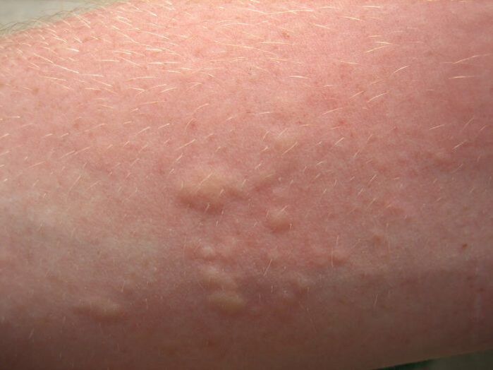 ruam kulit alergi gatal boleh menjadi gejala ascariasis