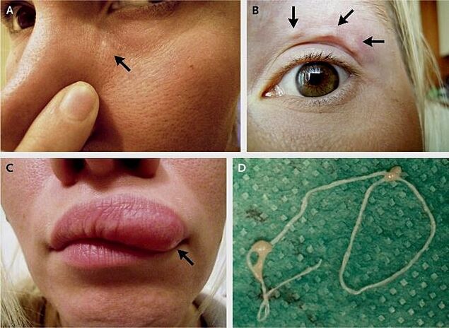 Manifestasi utama dirofilariasis pada muka